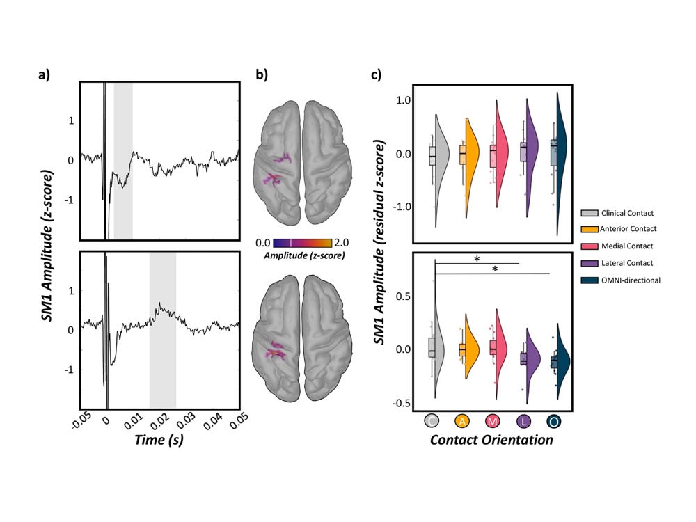 DBS-evoked cortical responses index optimal contact orientations and motor outcomes in Parkinson’s disease